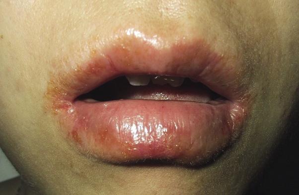 变应性接触性唇炎,湿疹,黏膜疾病