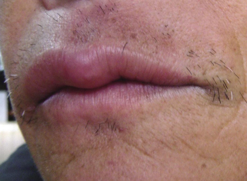 皮肤性病科图谱黏膜疾病肉芽肿性唇炎