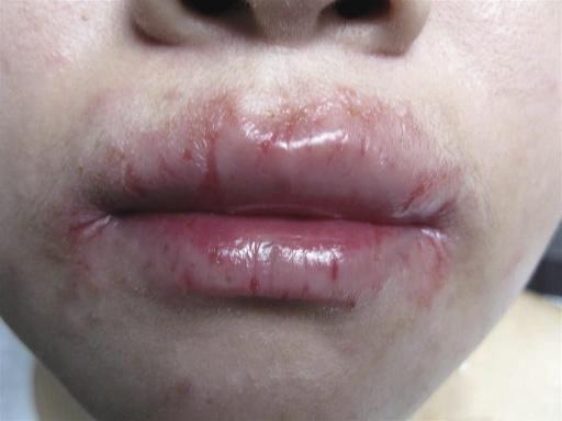 浆细胞性唇炎,水肿,黏膜疾病