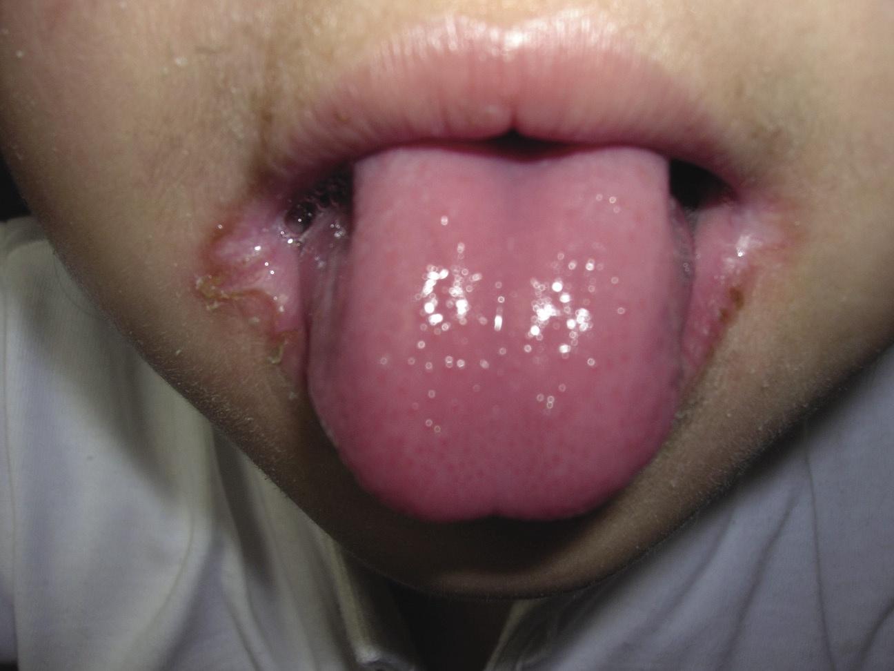 舌炎,口角炎,黏膜疾病