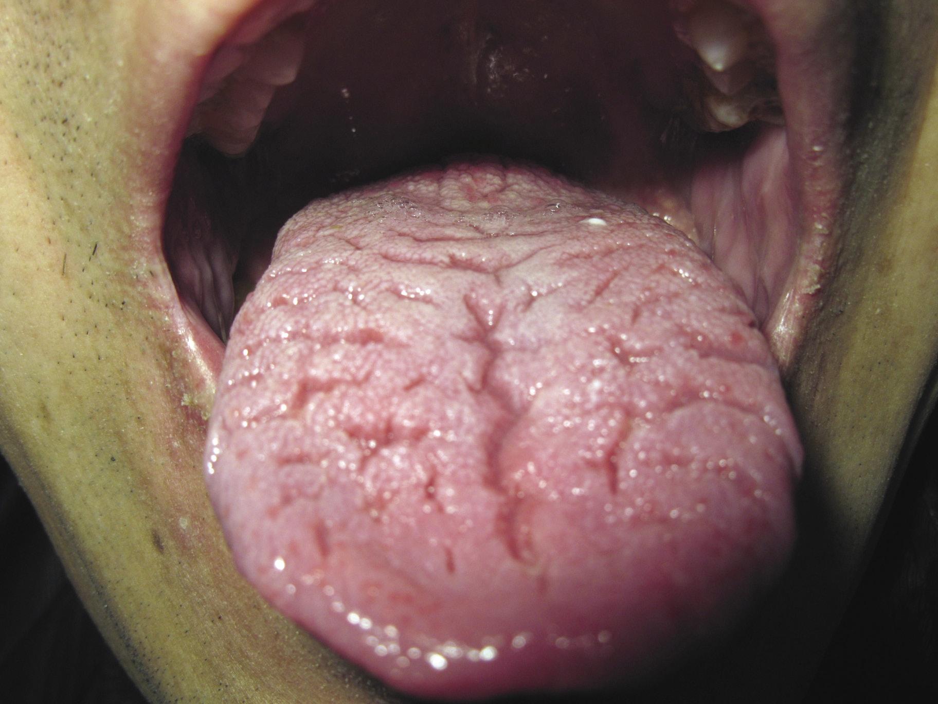 皱襞舌,银屑病,水肿,黏膜疾病