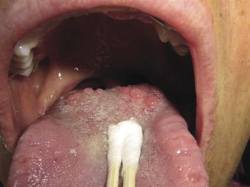 口腔乳头状瘤早期图片图片