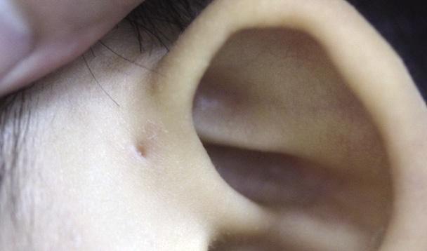 先天性耳瘘,遗传及先天性皮肤病