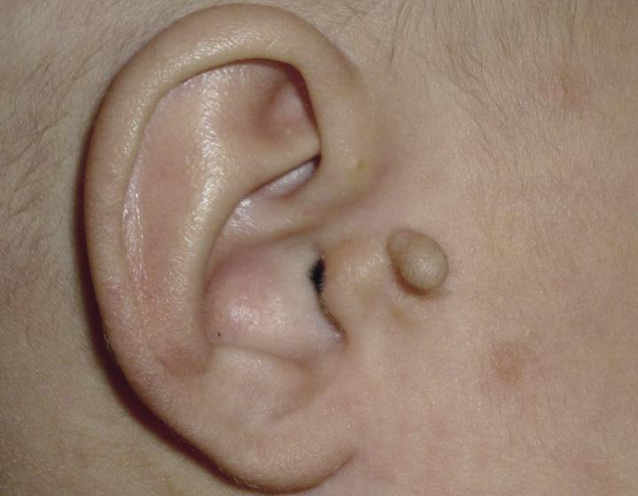 副耳,遗传及先天性皮肤病