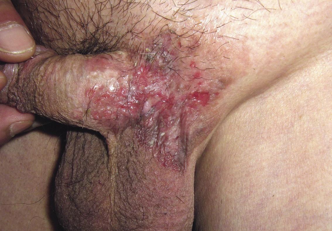 皮肤肿瘤,乳房外Paget病