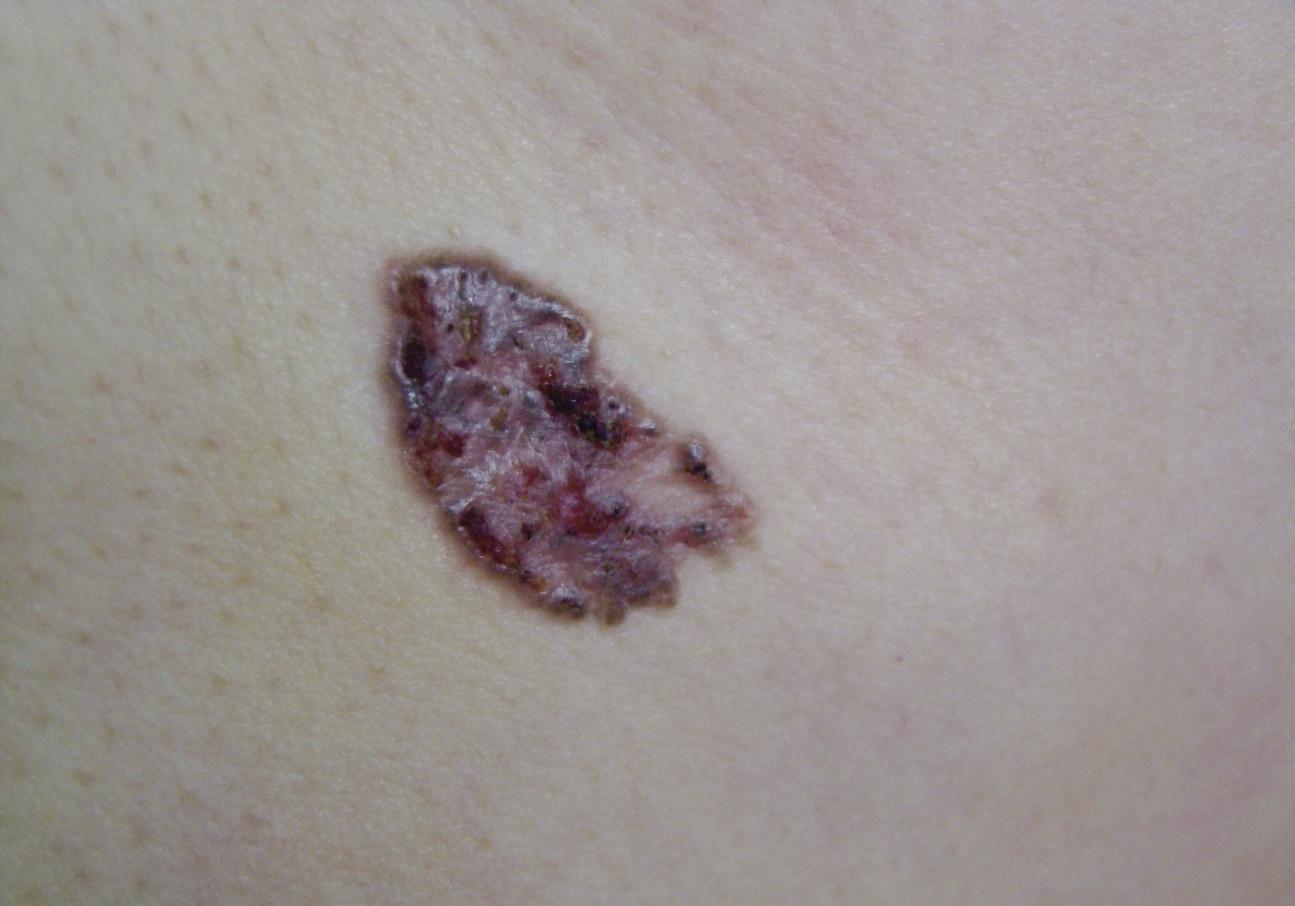 皮肤肿瘤,基底细胞癌