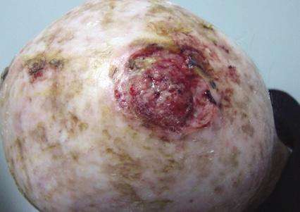 皮肤肿瘤,鳞状细胞癌