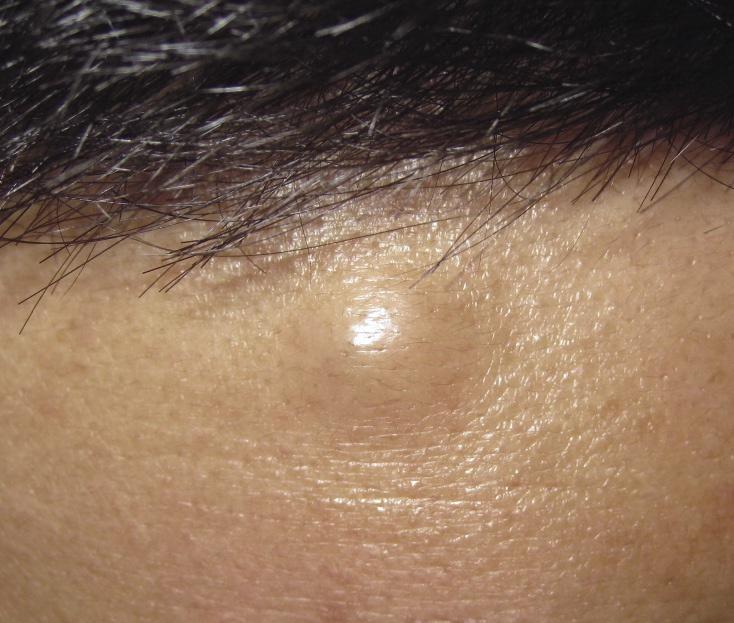 皮肤性病科图谱: 皮肤肿瘤 表皮囊肿