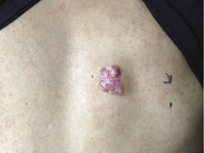 皮肤肉瘤早期图片图片