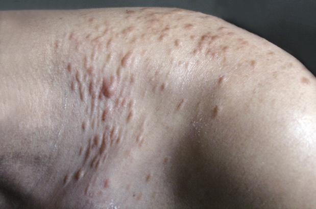 平滑肌瘤图片 平滑肌瘤症状图 平滑肌瘤病例图 皮肤性病科图谱皮肤