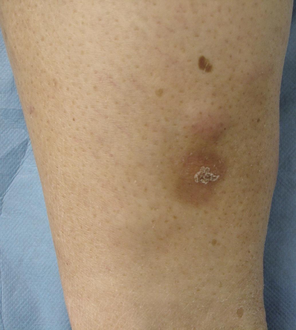 皮肤肿瘤,淋巴瘤,原发性皮肤弥漫性大B细胞淋巴瘤（腿型）