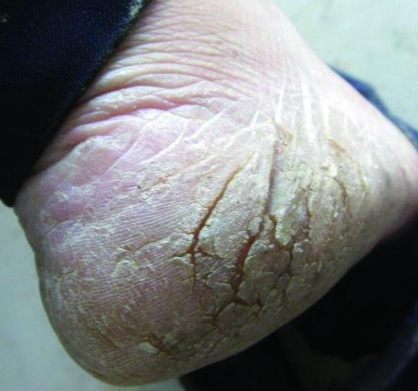 手足皲裂,物理性皮肤病