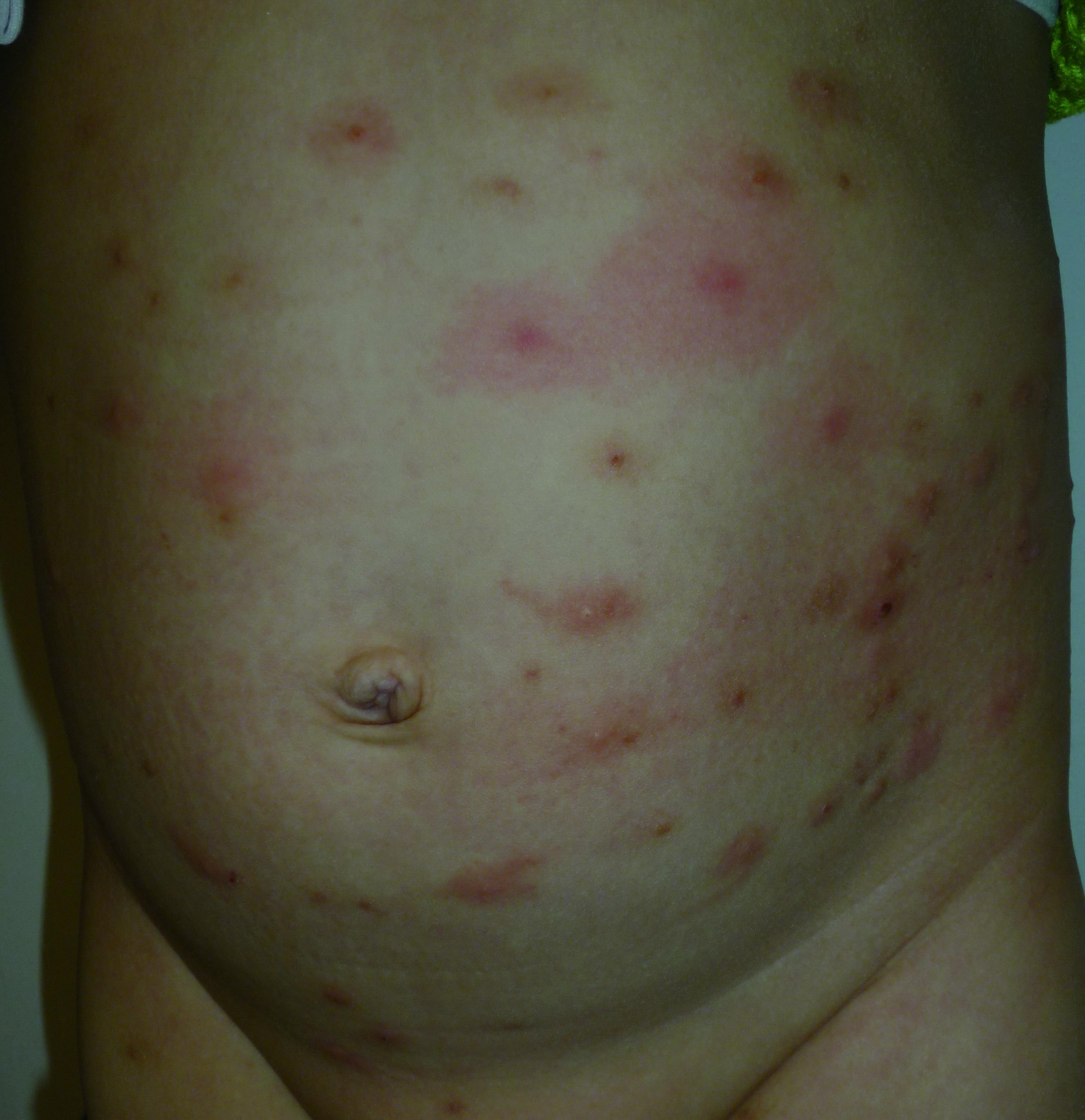 丘疹性荨麻疹,荨麻疹,麻疹,变态反应性疾病
