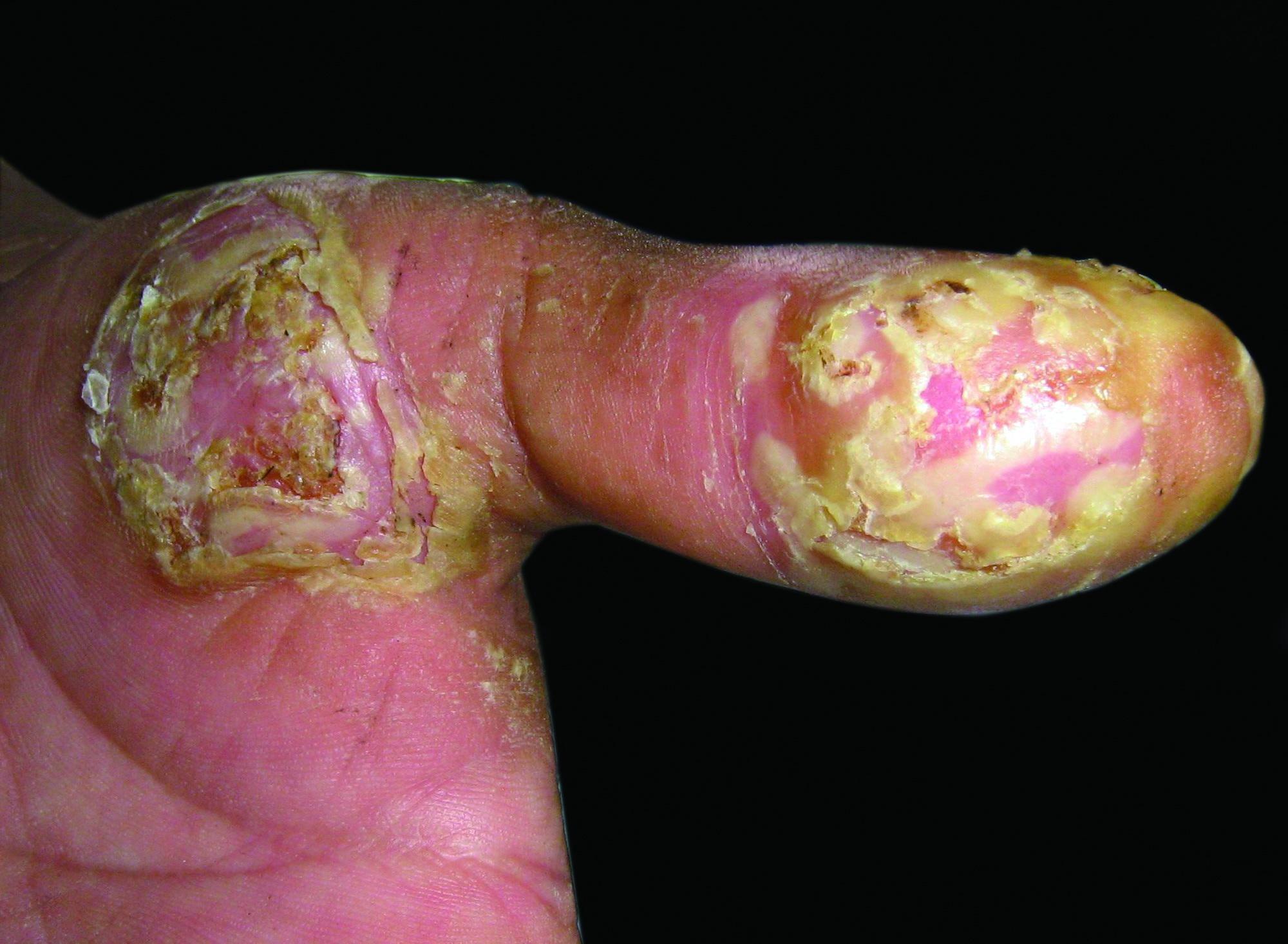 连续性肢端皮炎,皮炎, 无菌性脓疱性皮肤病