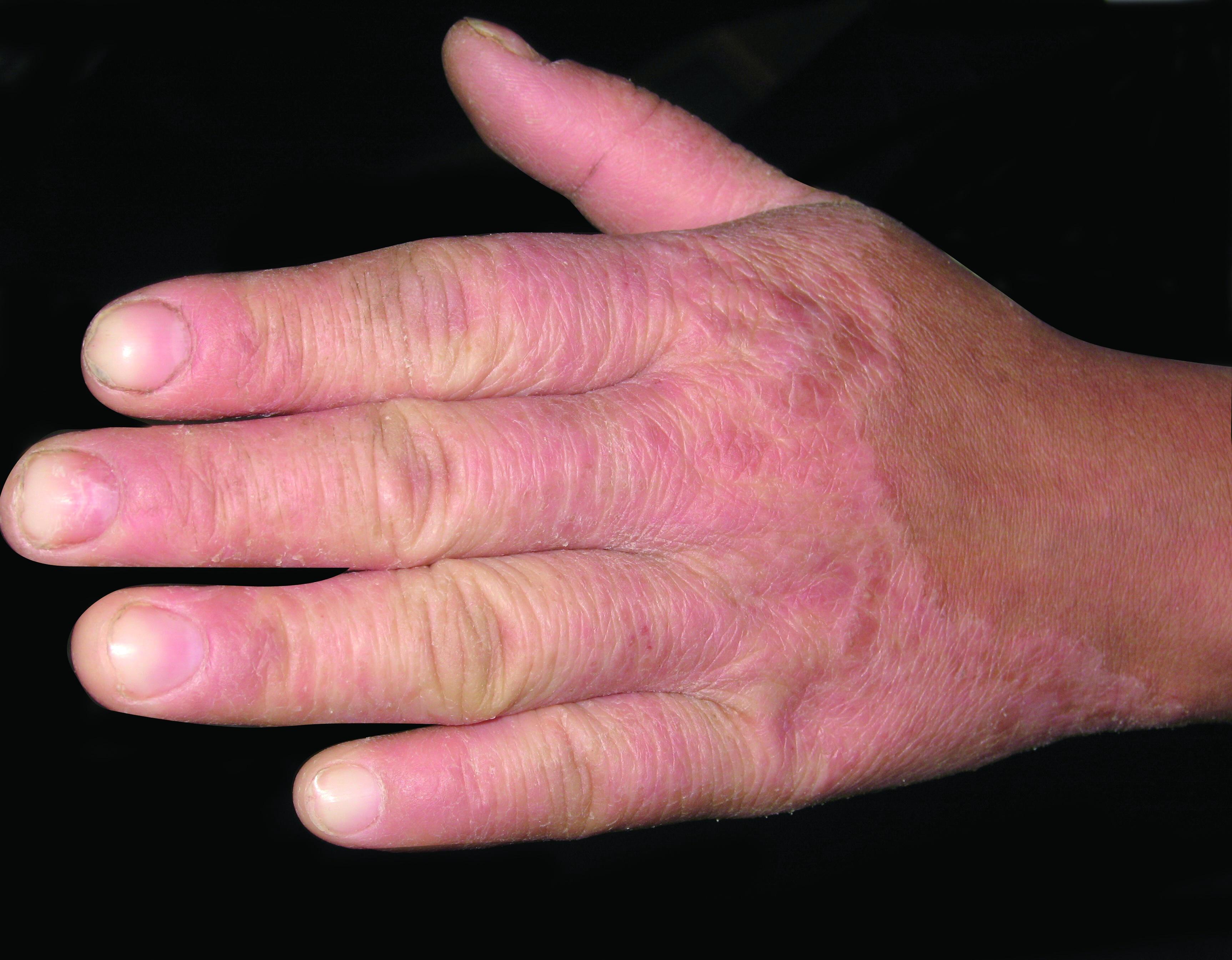 手足癣,接触性皮炎,细菌感染,丹毒,湿疹,皮炎,真菌性皮肤病