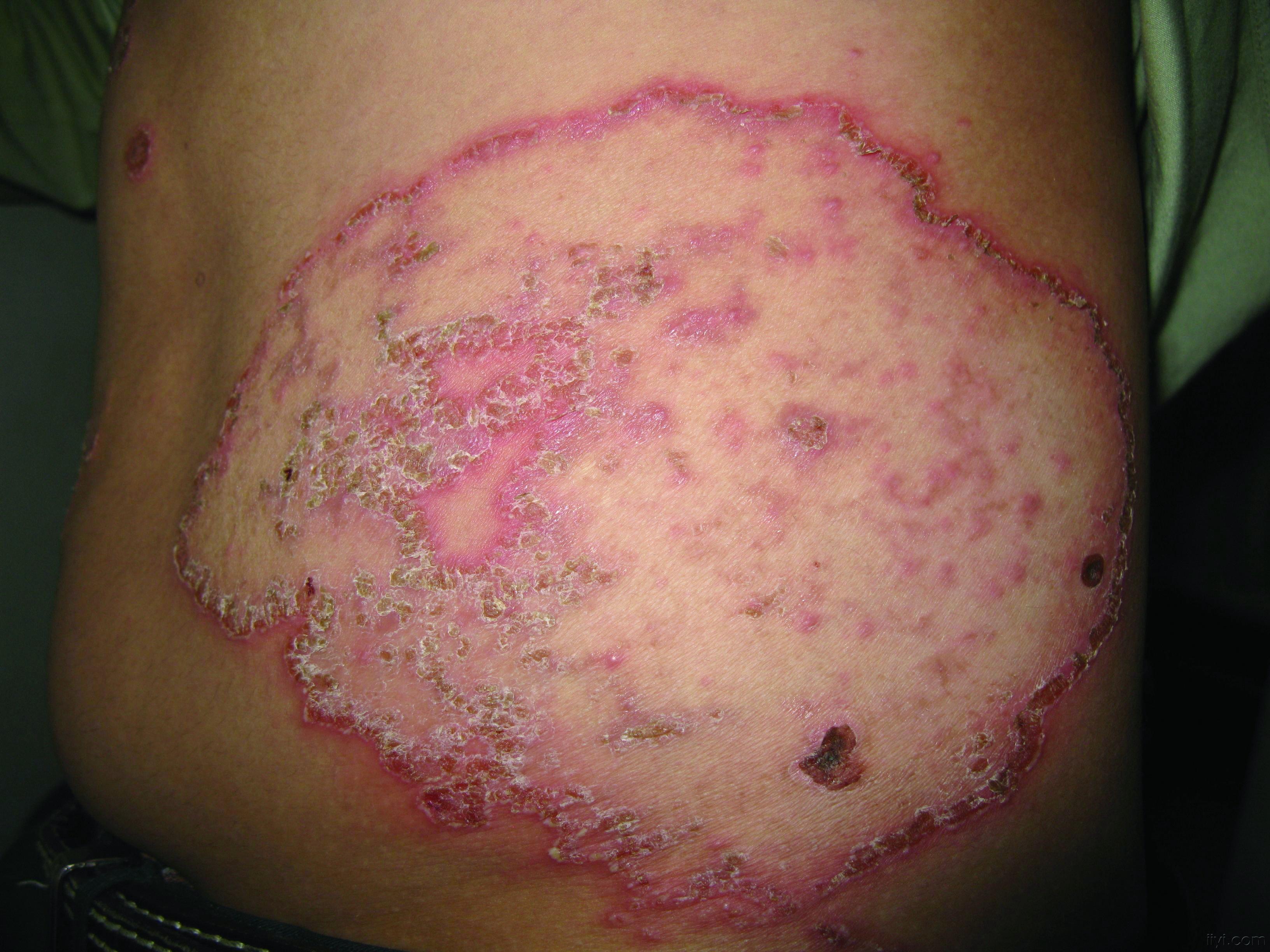 皮炎湿疹照片图片