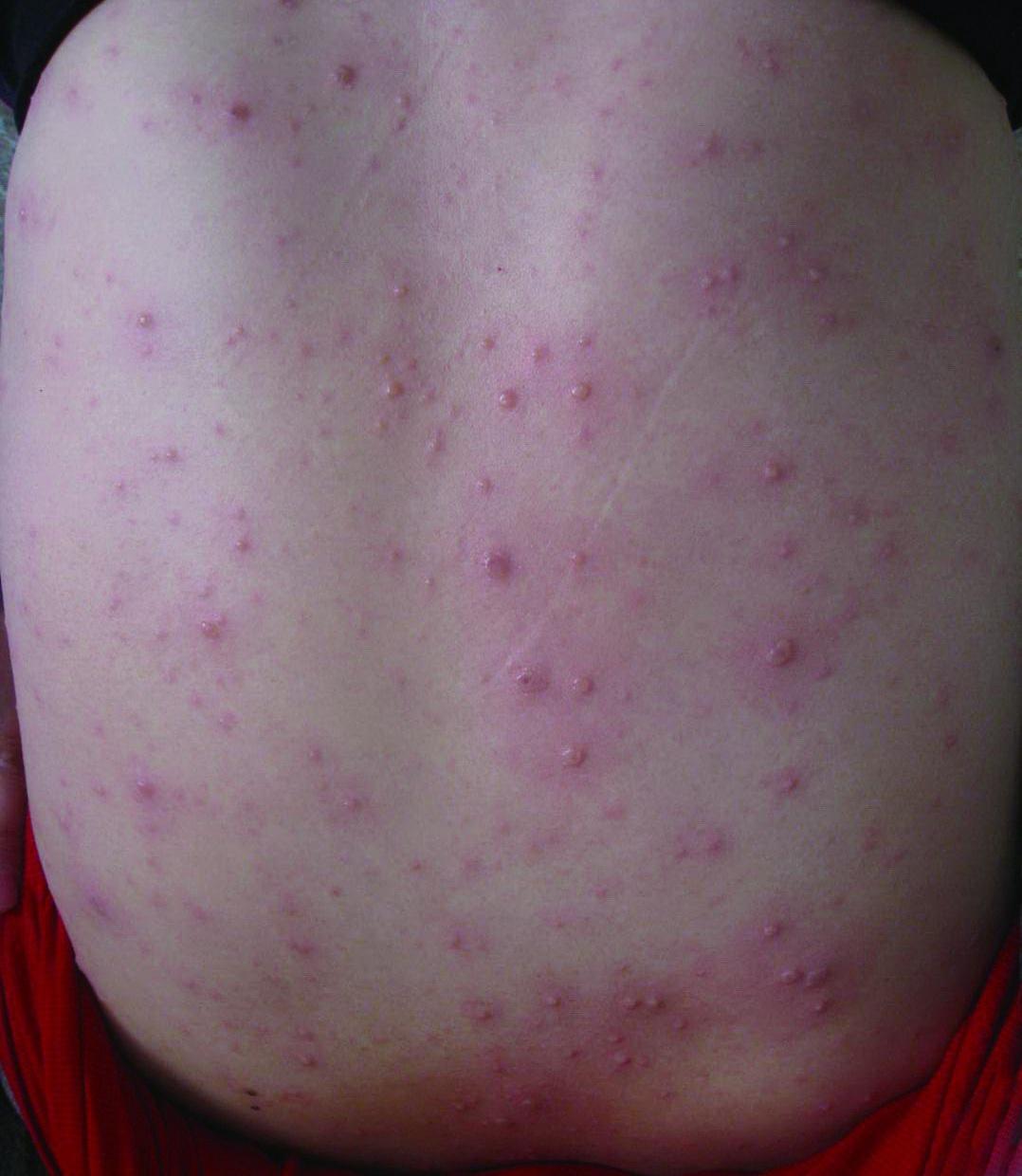 水痘的主要症状图片