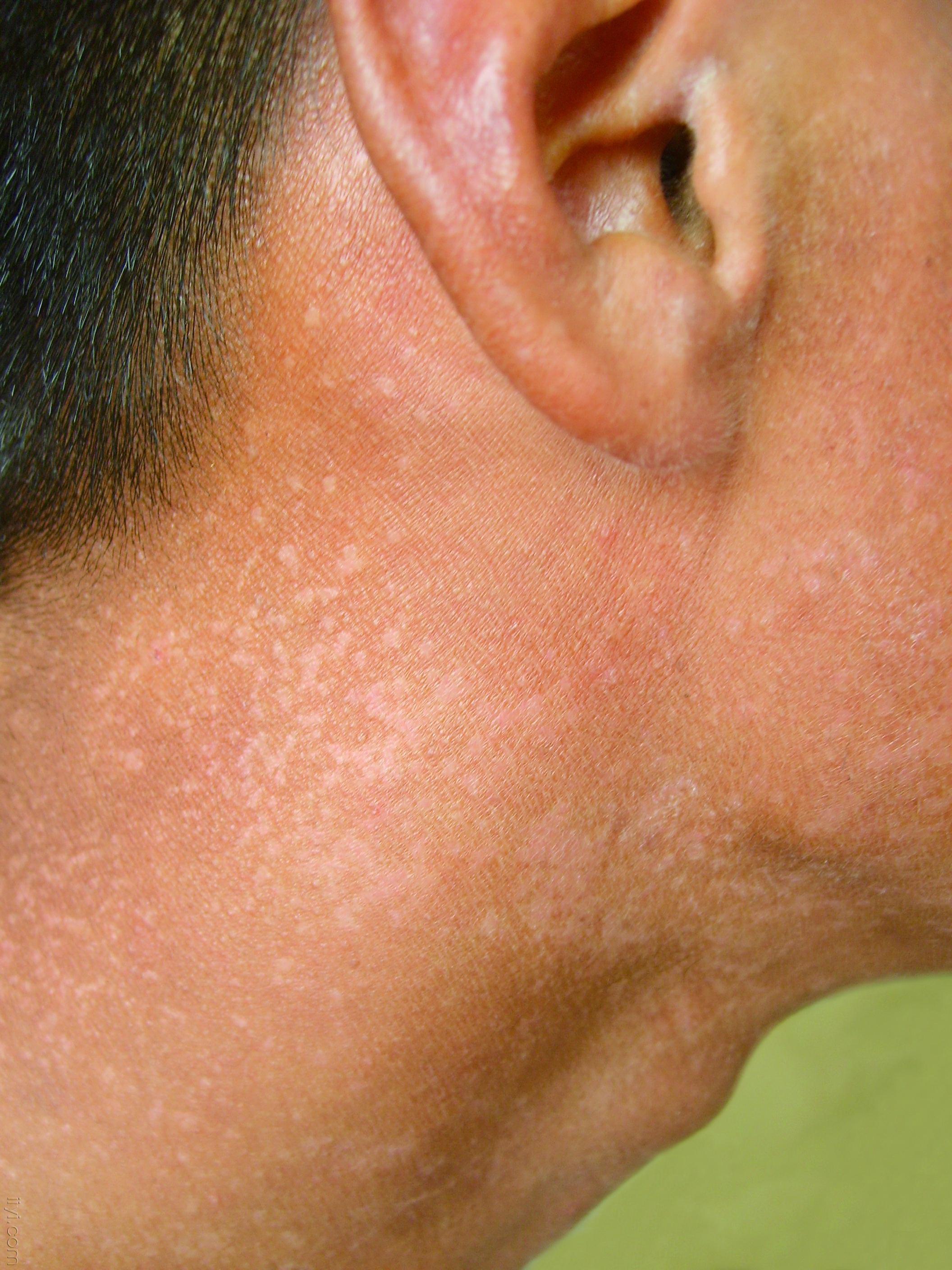 皮肤性病科图谱病毒性皮肤病疣状表皮发育不良