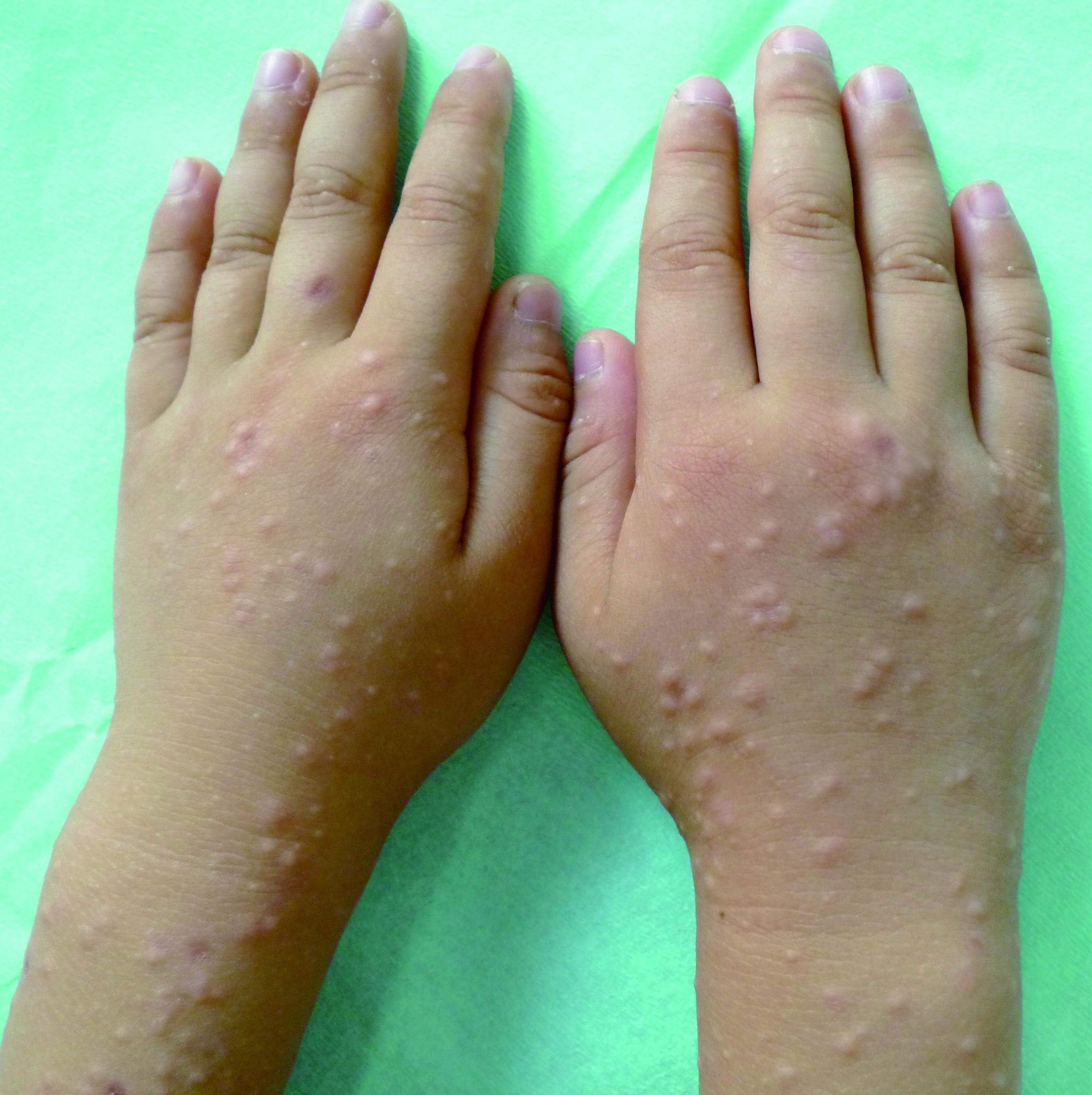 儿童丘疹性肢端皮炎症状图 儿童丘疹性肢端皮炎病例图 皮肤性病科图谱