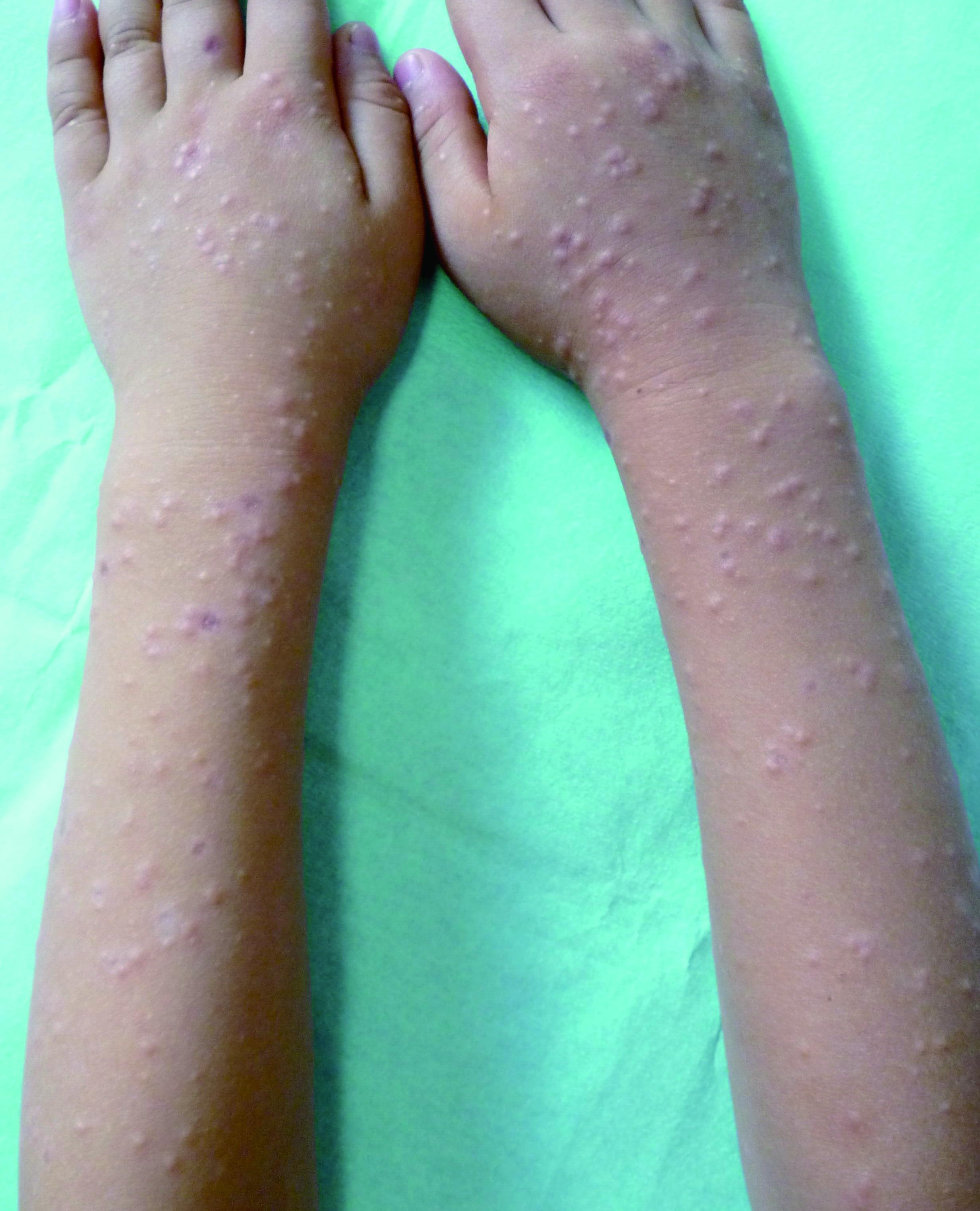 病毒皮肤感染症状图片图片
