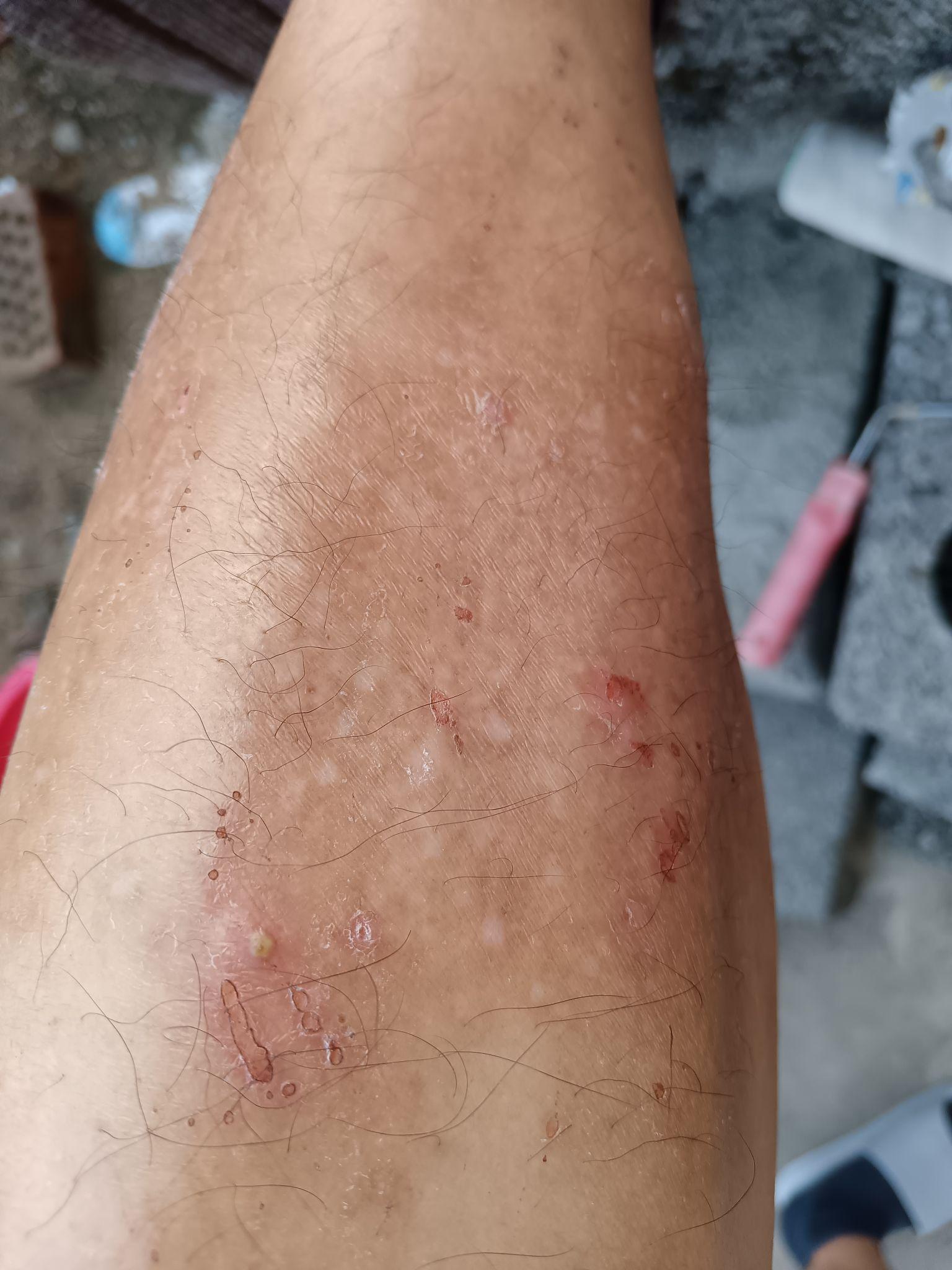 小腿肚子上,结伽厚粗,渍有微黄的液体,是细菌?还是真菌?