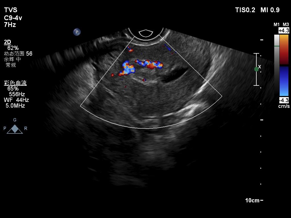 子宫动静脉瘘彩超图像图片